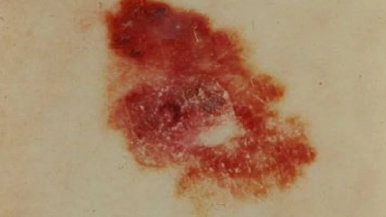 Recherche médicale sur le cancer de la peau