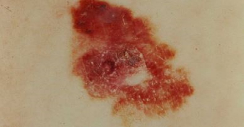 Des chercheuses israéliennes découvrent comment le cancer de la peau devient mortel